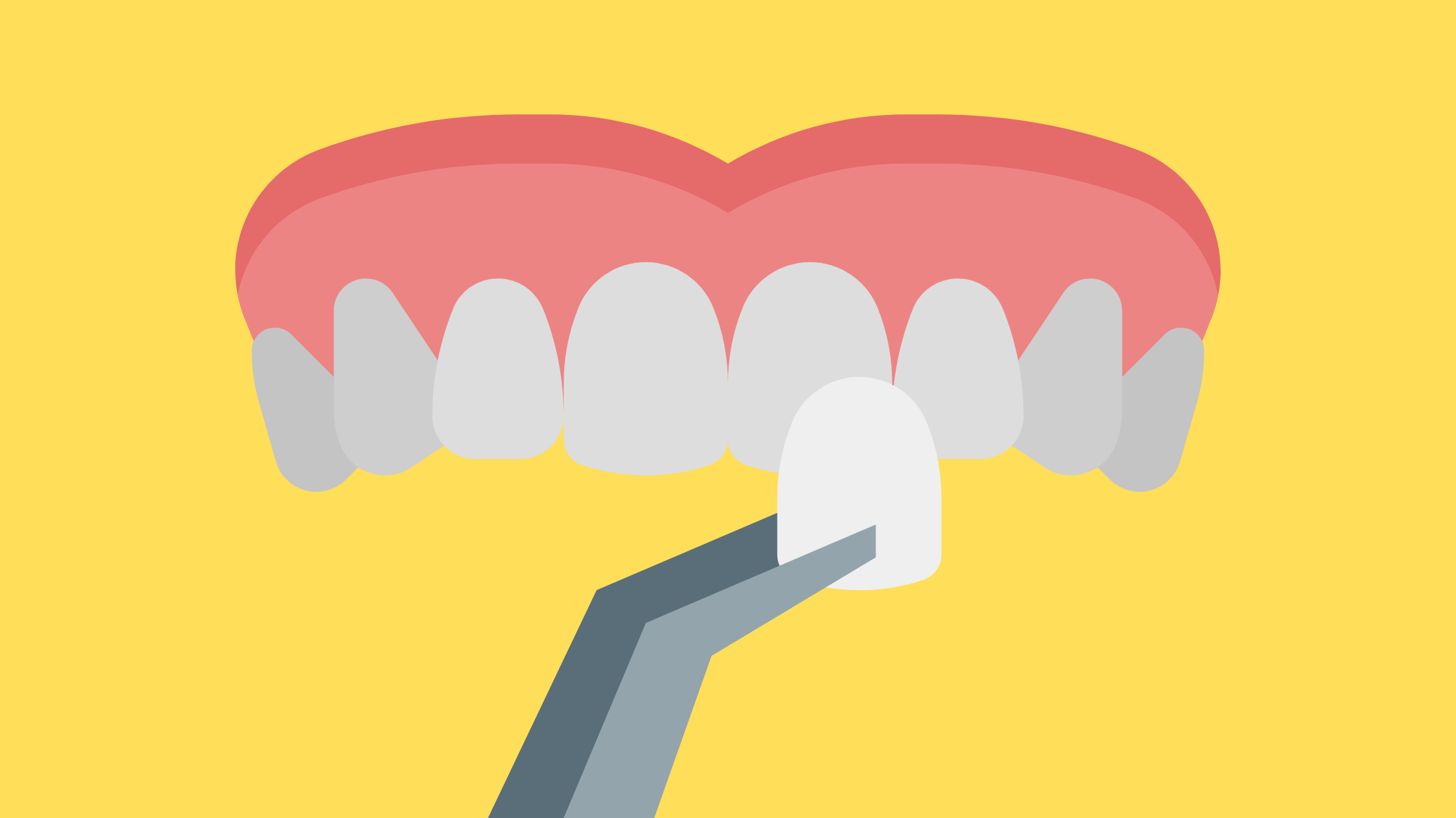 Pros And Cons Of Dental Veneers 