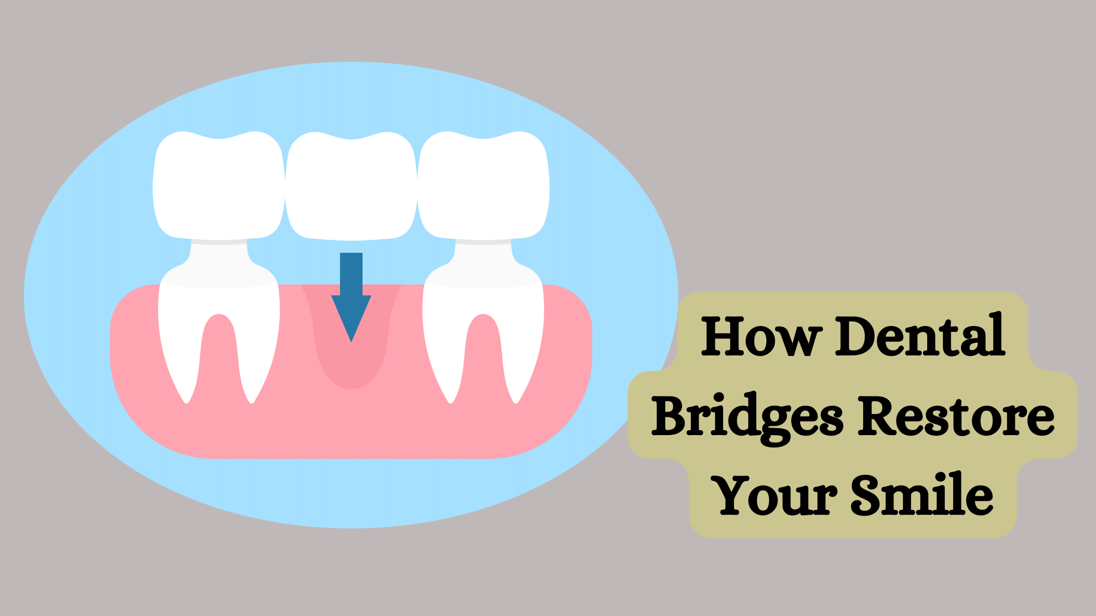 Dental Bridges Restore Your Smile